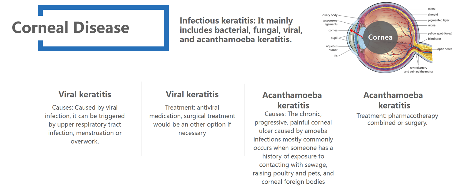 Corneal Disease_02
