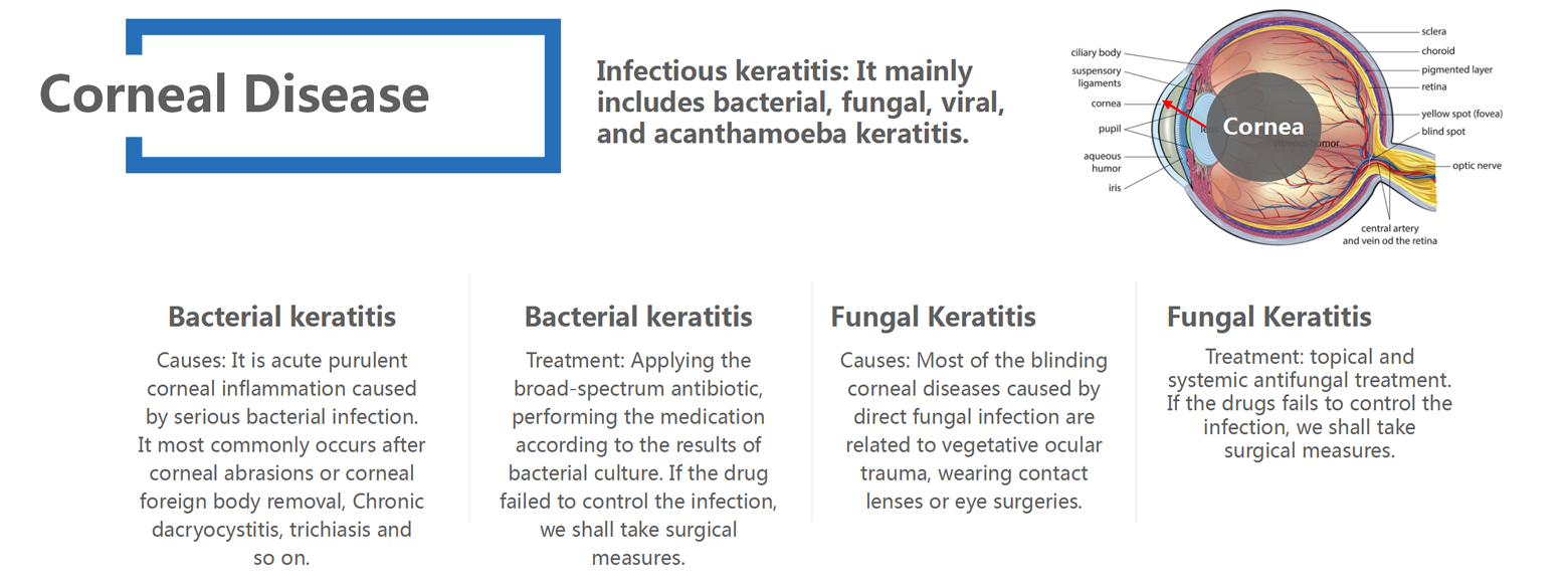 Corneal Disease_01